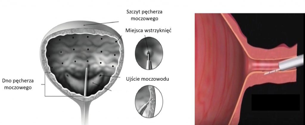 Budowa pęcherza moczowego